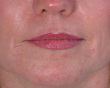 Laser Skin Resurfacing before and after photo