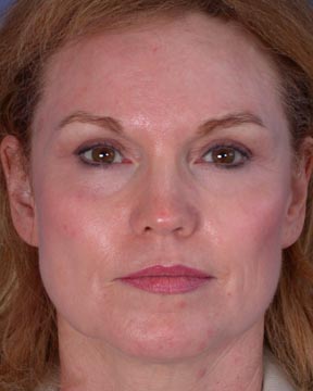 Laser Skin Resurfacing before and after photo