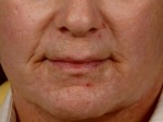 Laser Skin Resurfacing Before and after photo