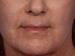 Laser Skin Resurfacing Before and after photo