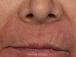 Laser Skin Resurfacing Before and after photo