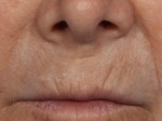 Laser Skin Resurfacing Before and after photo