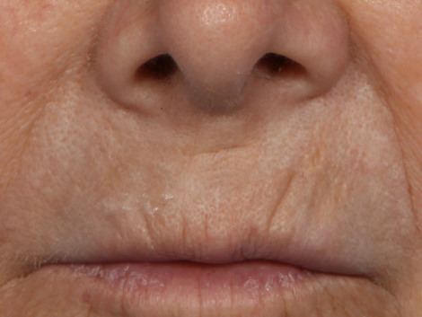 Laser Skin Resurfacing before and after photo