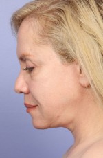 Laser Skin Resurfacing Before and after photo