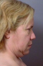 Laser Skin Resurfacing Before and after photo