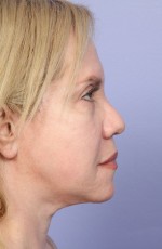 Laser Skin Resurfacing Before and after photo