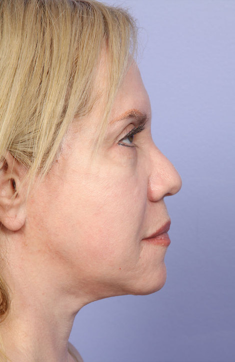 Laser Skin Resurfacing before and after photo