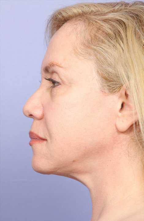 Laser Skin Resurfacing before and after photo