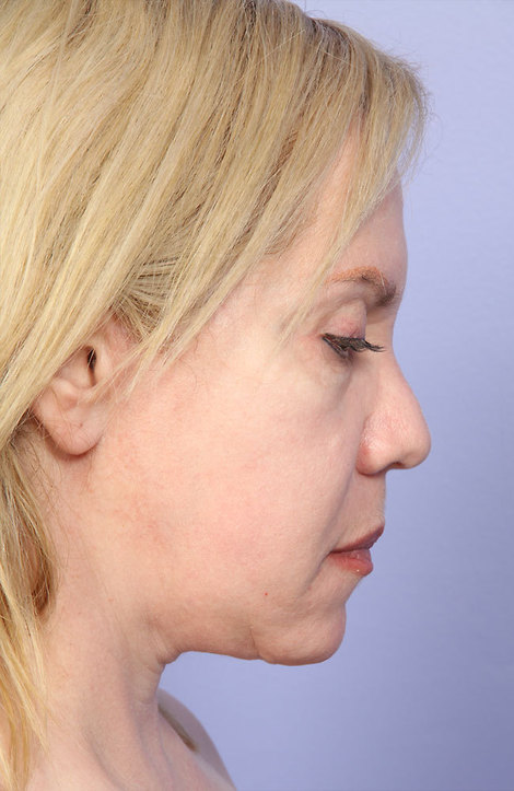 Laser Skin Resurfacing before and after photo