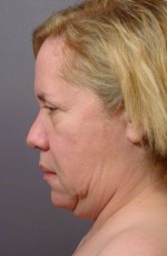 Laser Skin Resurfacing Before and after photo