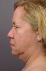 Laser Skin Resurfacing Before and after photo