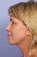 Laser Skin Resurfacing Before and after photo