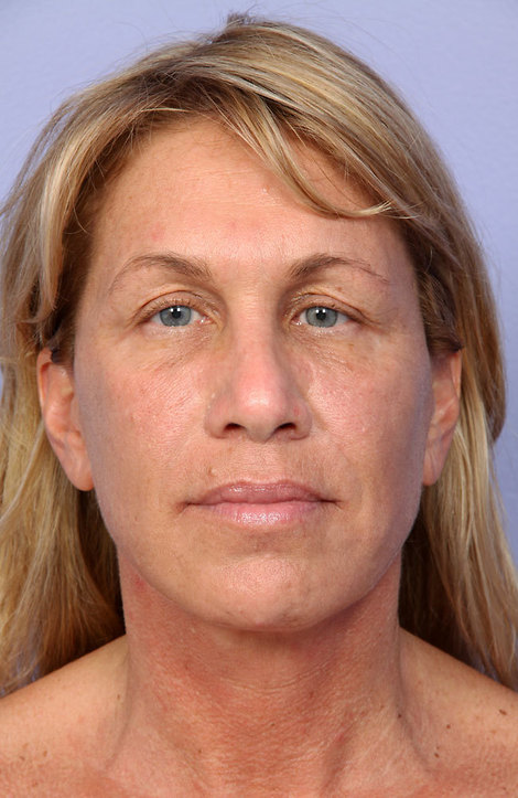 Laser Skin Resurfacing before and after photo