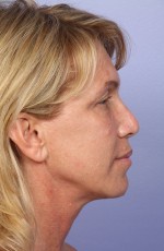 Laser Skin Resurfacing Before and after photo