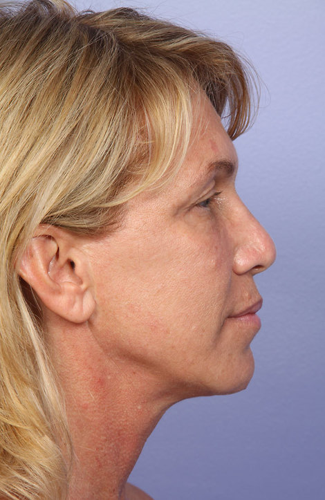 Laser Skin Resurfacing before and after photo