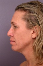 Laser Skin Resurfacing Before and after photo