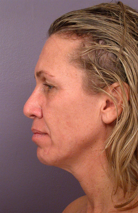 Laser Skin Resurfacing before and after photo