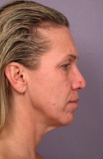 Laser Skin Resurfacing Before and after photo