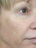 Laser Skin Resurfacing Before and after photo