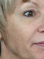 Laser Skin Resurfacing Before and after photo