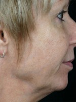 Laser Skin Resurfacing Before and after photo