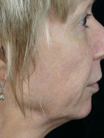 Laser Skin Resurfacing Before and after photo