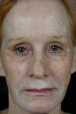 Laser Skin Resurfacing Before and after photo