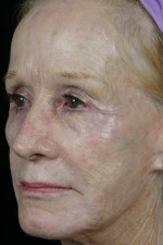 Laser Skin Resurfacing Before and after photo