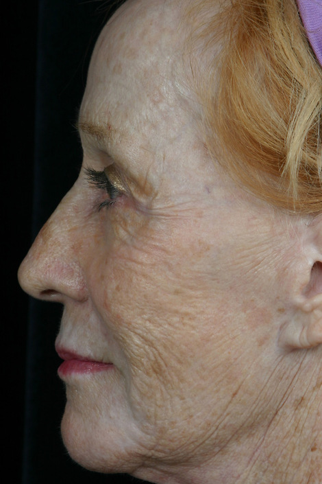 Laser Skin Resurfacing before and after photo