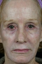 Laser Skin Resurfacing Before and after photo