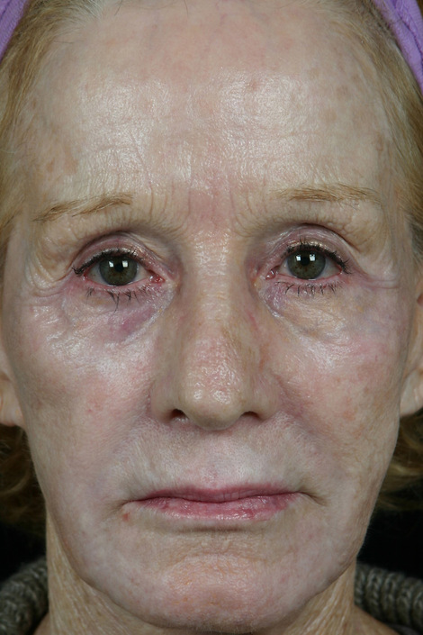 Laser Skin Resurfacing before and after photo