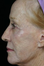 Laser Skin Resurfacing Before and after photo