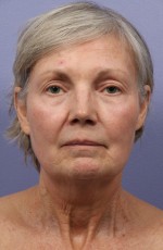 Laser Skin Resurfacing Before and after photo