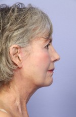 Laser Skin Resurfacing Before and after photo