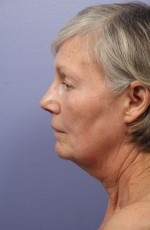 Laser Skin Resurfacing Before and after photo