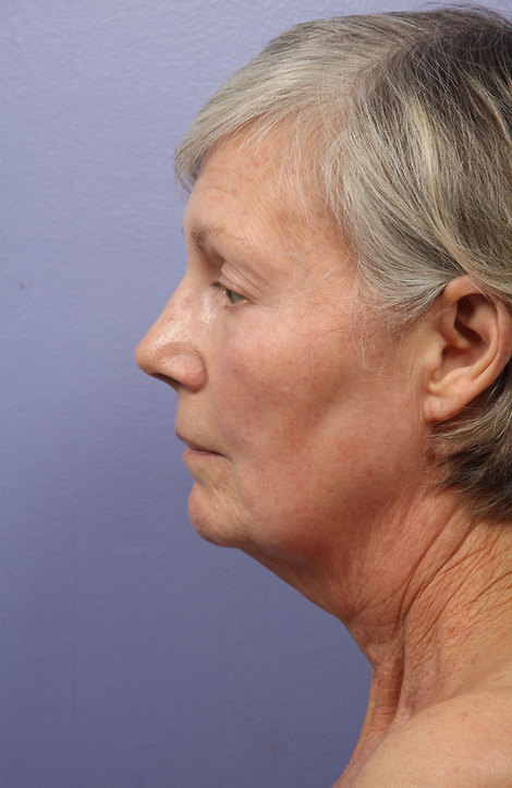 Laser Skin Resurfacing before and after photo