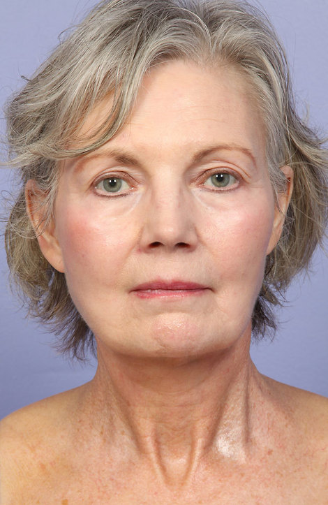 Laser Skin Resurfacing before and after photo