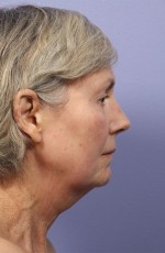 Laser Skin Resurfacing Before and after photo