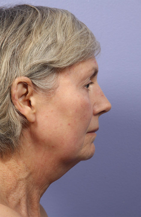 Laser Skin Resurfacing before and after photo