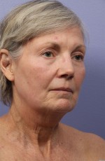 Laser Skin Resurfacing Before and after photo