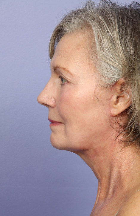 Laser Skin Resurfacing before and after photo