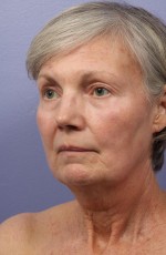 Laser Skin Resurfacing Before and after photo