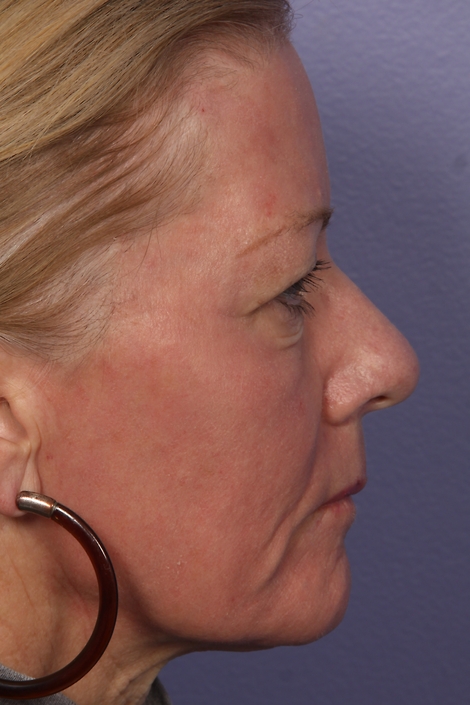 Laser Skin Resurfacing before and after photo