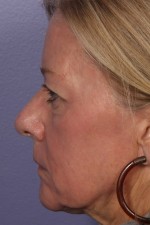 Laser Skin Resurfacing Before and after photo