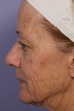 Laser Skin Resurfacing Before and after photo