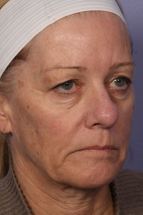 Laser Skin Resurfacing before and after photo