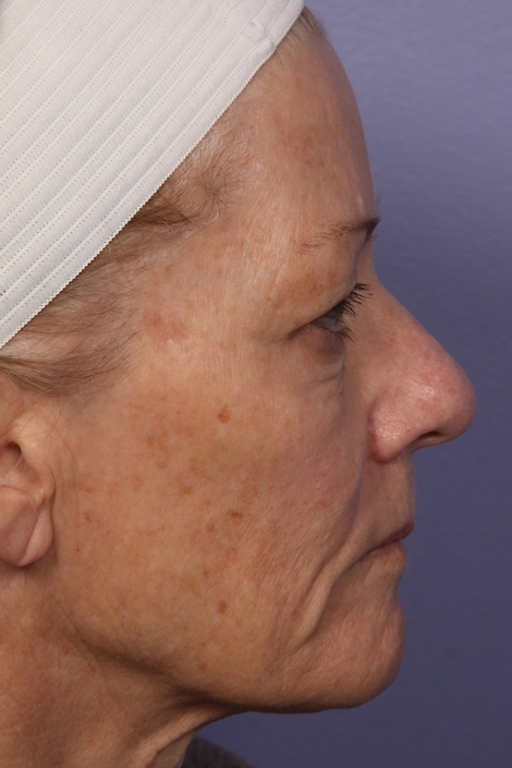 Laser Skin Resurfacing before and after photo