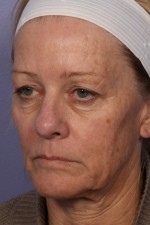 Laser Skin Resurfacing Before and after photo