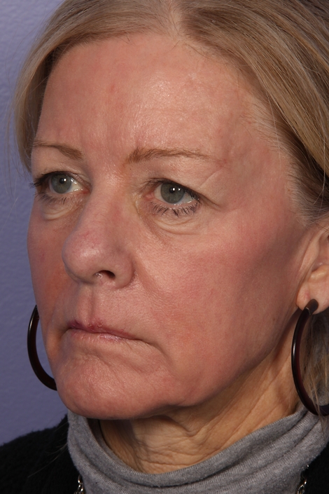 Laser Skin Resurfacing before and after photo