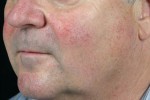 Laser Skin Resurfacing Before and after photo